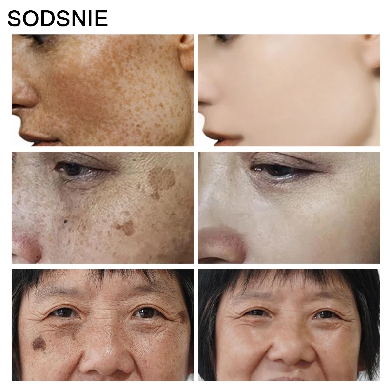 ビタミンEベースのホワイトニングを備えたダークスポットリムー - Skincare Niacinamide のレビューと価格